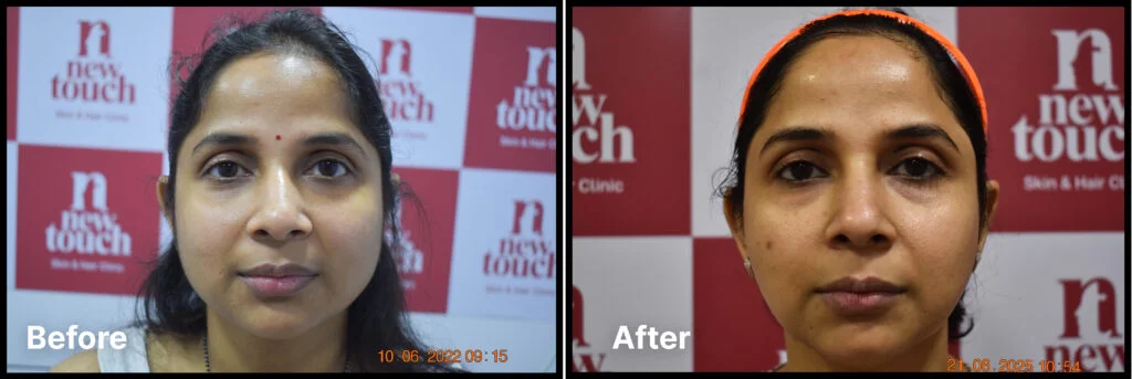 Skincare peel