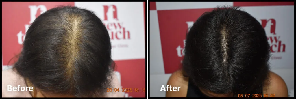 Skincare peel