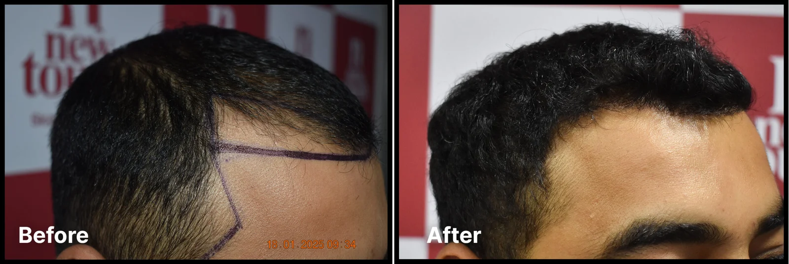 Skincare peel
