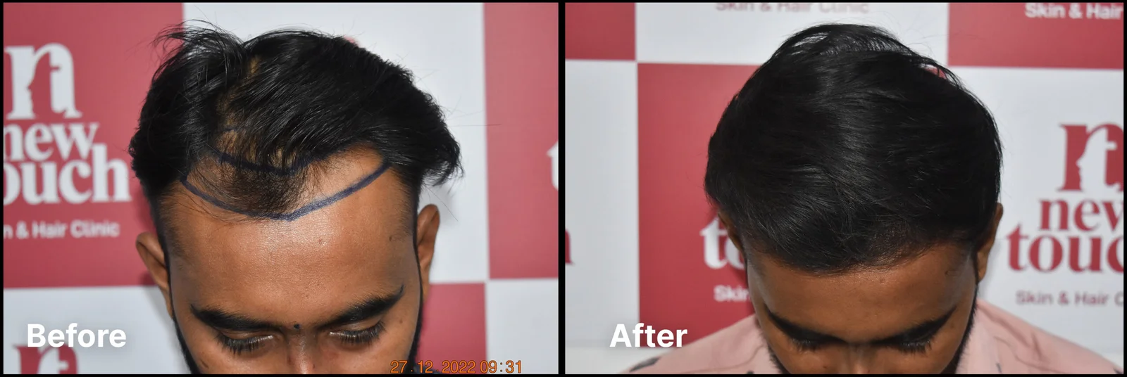 Laser treatment
