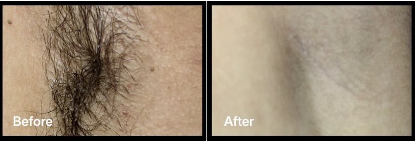 Skincare peel
