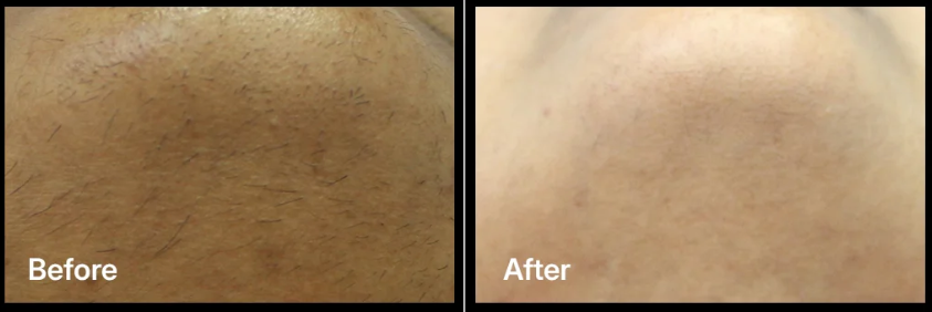 Laser treatment