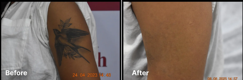 Laser treatment